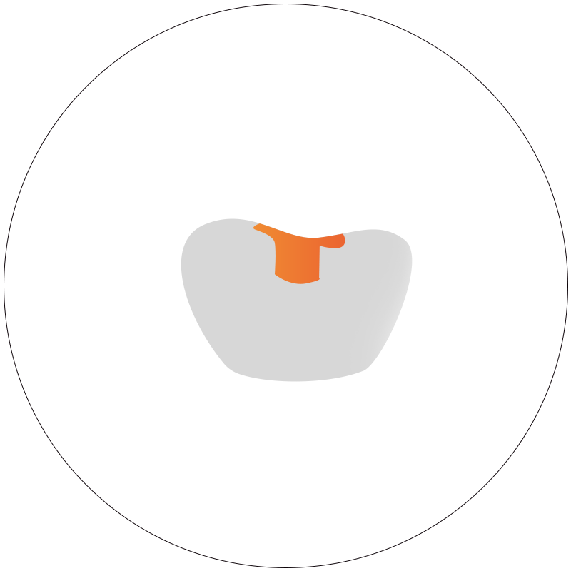 ترصيع